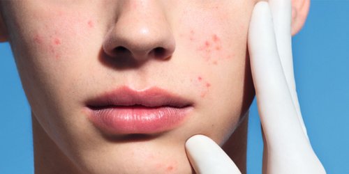 Todavía Cadera sabio Qué causa la piel grasa con tendencia al acné? ¿Cómo prevenirla?